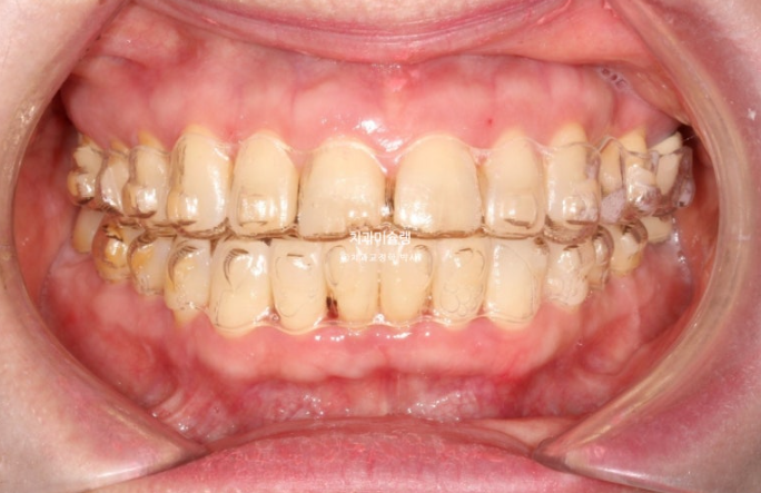 50대 치아교정 돌출 치아벌어짐 중년교정 관련 이미지 10