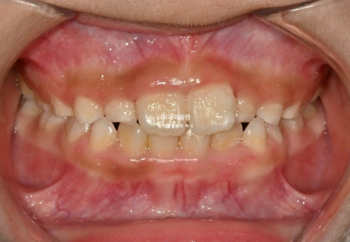 7세 어린이 반대교합 부정교합 프리올소 치료 관련 이미지 7
