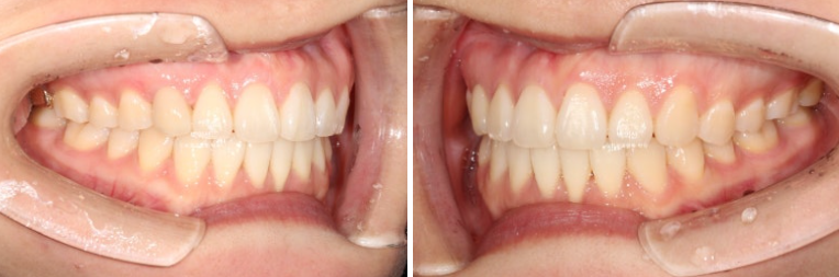 매복 결손 잔존유치 라미네이트 크라운 캔팅 인비절라인 라이트 치료 관련 이미지 17