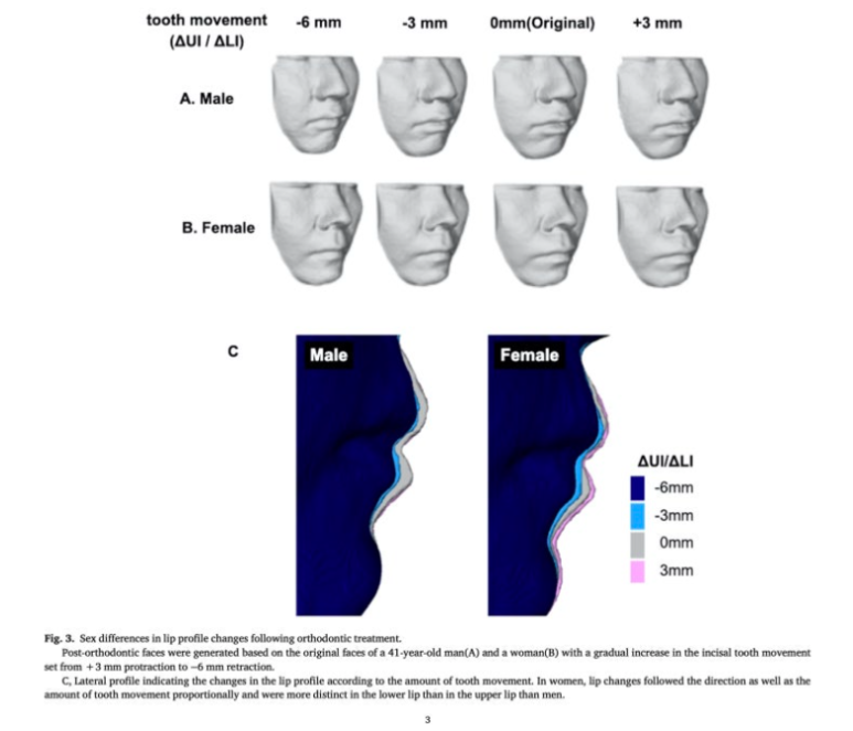 교정치료 입매 변화 남녀차이 연구 Seminars in Orthodontics저널 연구 눈문 등재 관련 이미지 2