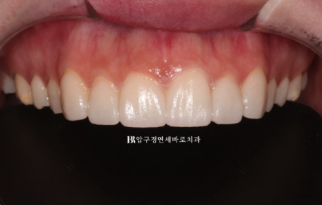 강남 무삭제 라미네이트, 치아 삭제 없이 스마일라인까지 바꿀 수 있을까? 관련 이미지 7