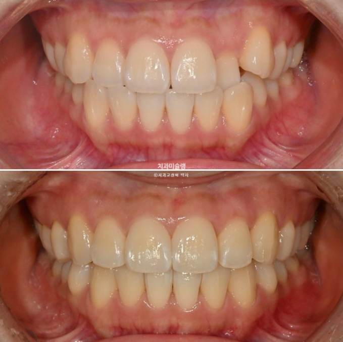 인비절라인 라이트 반대교합? 덧니 중심선 치간삭제 치료 관련 이미지 15