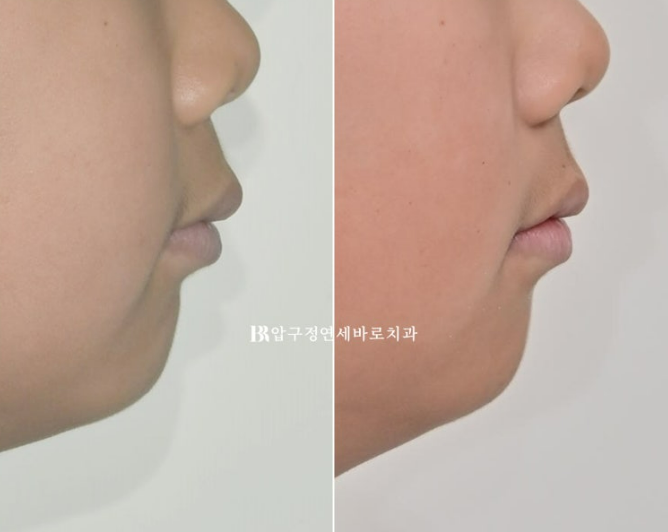 무턱교정 어린이 투명교정 인비절라인 퍼스트 교정 후기 관련 이미지 24