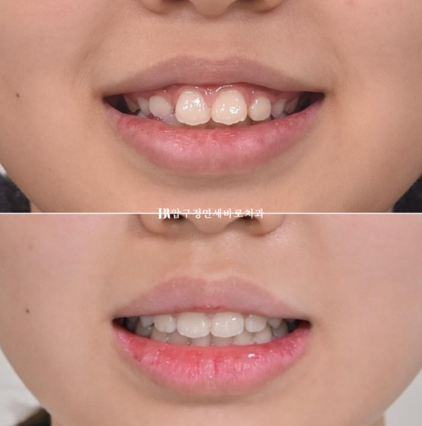 A Child’s Protruding Teeth Correction Review: Difficulty Closing the Lips image 15