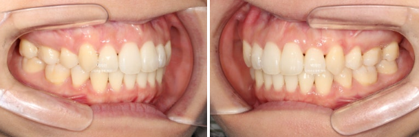 30대 돌출입 덧니 교정 인비절라인 발치교정 후기 관련 이미지 14