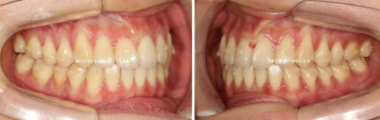 인비절라인 익스프레스 토끼이빨 앞니교정 ? 관련 이미지 7
