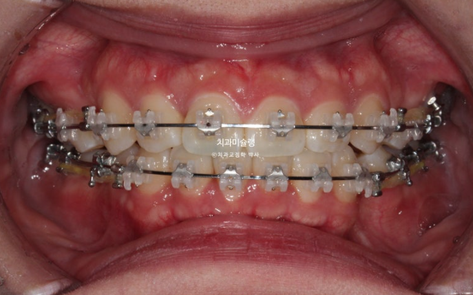 잇몸미소 거미스마일 치료 옥니 교정 잇몸성형 후기 관련 이미지 8