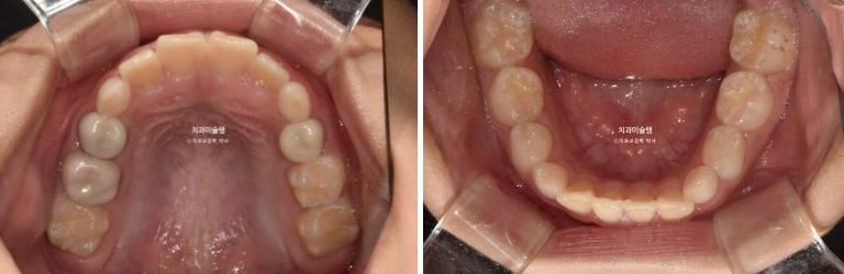 어린이 돌출입 교정 무턱 투명교정 인비절라인 퍼스트 관련 이미지 4