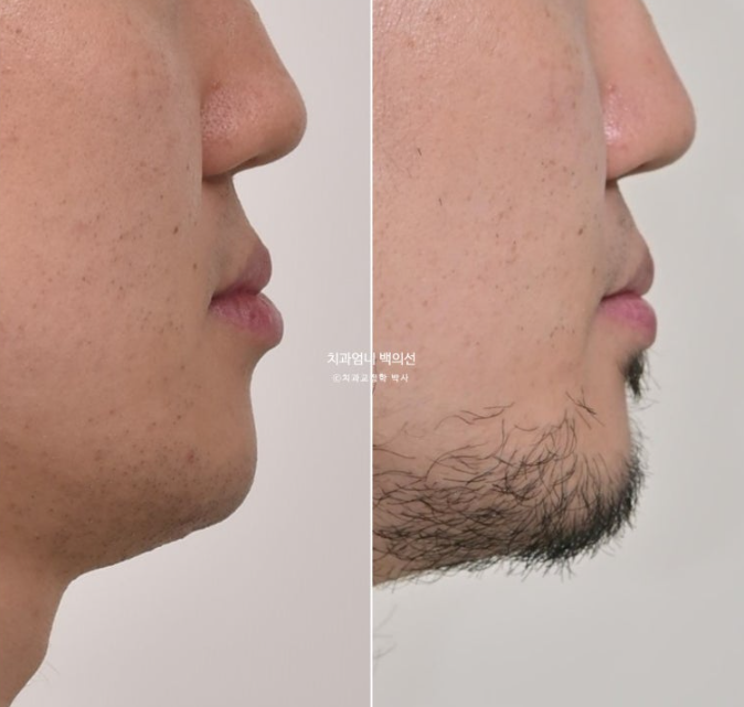 주걱턱 교정 반대교합 소구치 선천적 결손 부정교합 비발치 교정 후기 관련 이미지 15