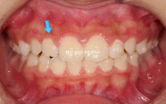 강남 소아교정 인비절라인 퍼스트 어린이 반대교합 관련 이미지 9