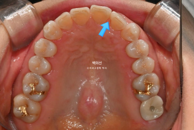 50대 치아교정 :: 인비절라인 익스프레스 치아 벌어짐 단기교정 후기 관련 이미지 5