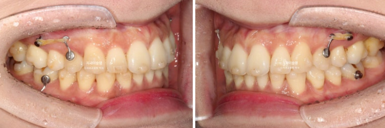 비발치 돌출입 인비절라인 교정 가위교합 중심선 맞추기 관련 이미지 15