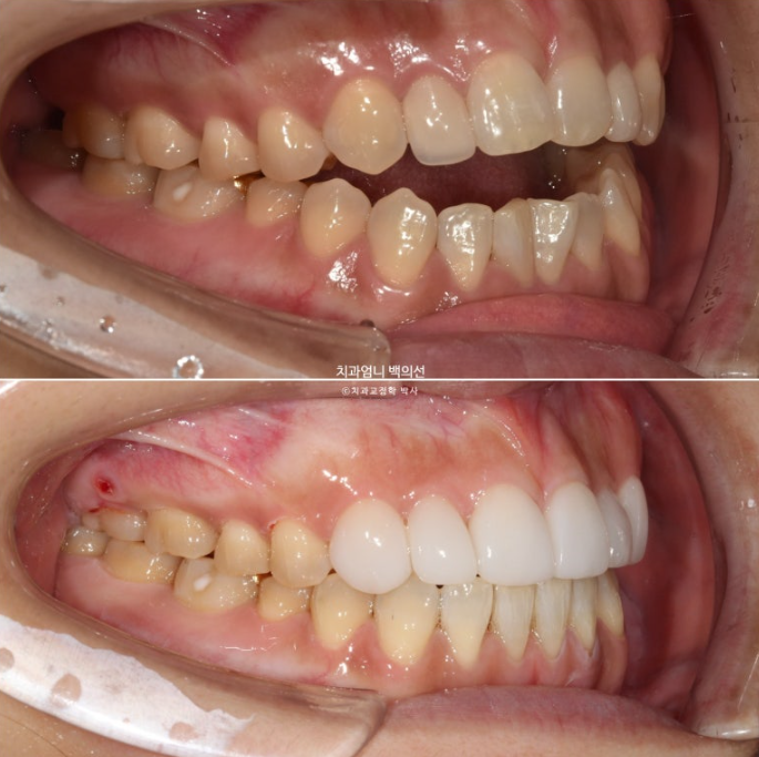 비수술 개방교합 클리피씨 30대 무삭제 라미네이트 치료기간 2년 관련 이미지 17