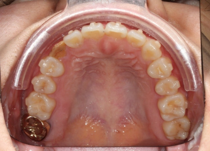 매복 결손 잔존유치 라미네이트 크라운 캔팅 인비절라인 라이트 치료 관련 이미지 12