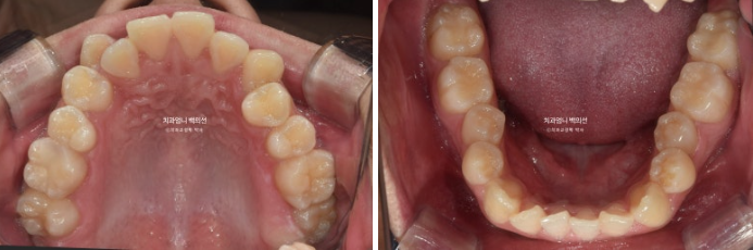 투명교정 인비절라인 덧니 교정 치료기간 알아보기 관련 이미지 4