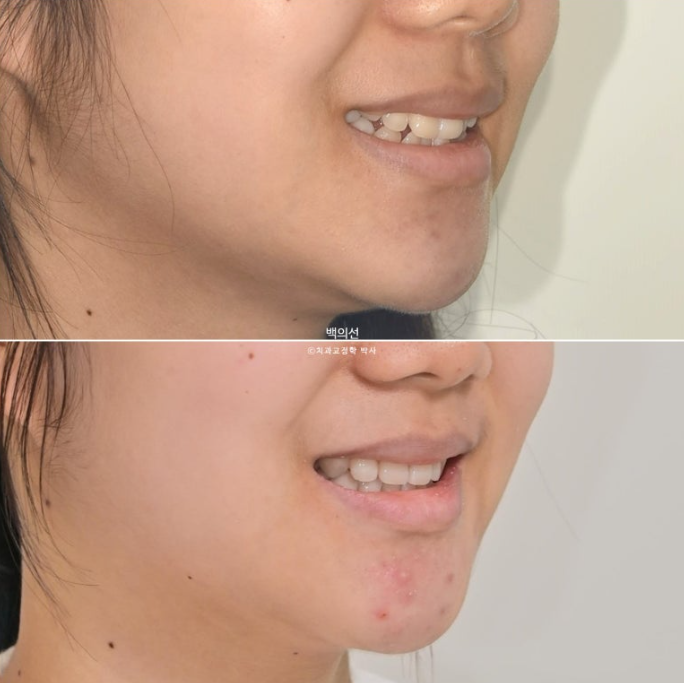 덧니 발치교정 클리피씨 입매 부작용 인중 입술 잇몸 퇴축 관련 이미지 1