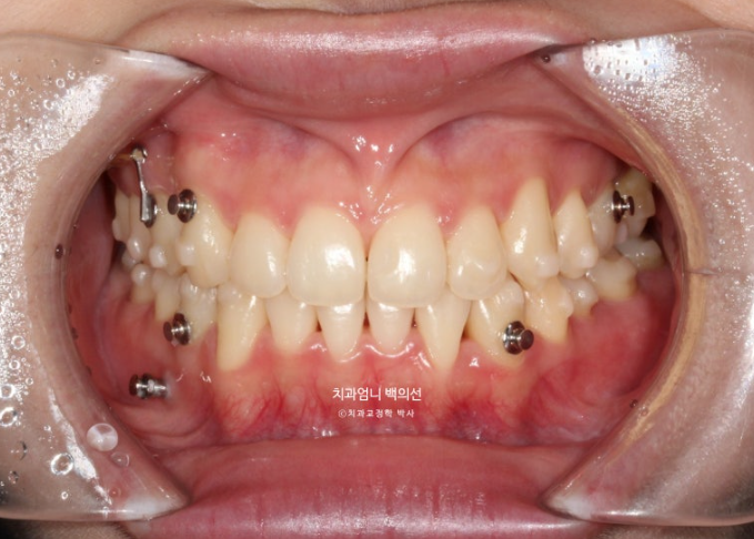 인비절라인 교정 비발치 비대칭 덧니 중심선 선천적 결손치 교정? 관련 이미지 8