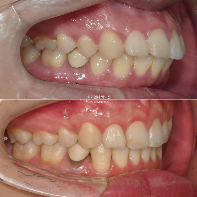 돌출입 발치 교정 인비절라인 후기 미니스크류 관련 이미지 19