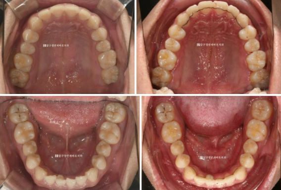 압구정 인비절라인 라이트 과개교합 후기 관련 이미지 9