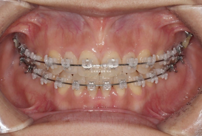 비수술 개방교합 클리피씨 30대 무삭제 라미네이트 치료기간 2년 관련 이미지 7