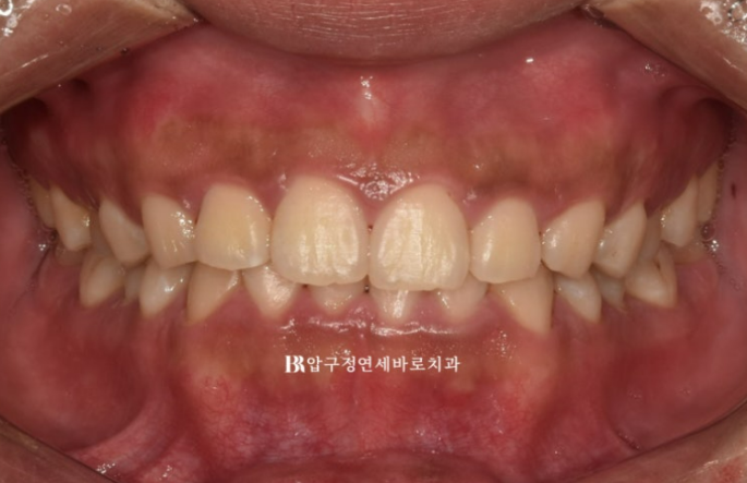 Can Invisalign Lite Correct Deep Bite and the Occlusal Plane? | A Real Case With 14 Aligners Over 4 Months image 1