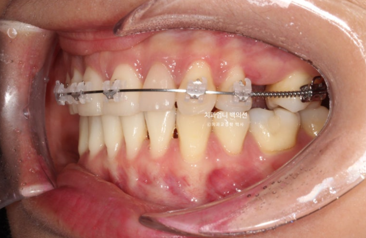 옥니 교정 역교정 재교정 무턱교정 치료기간 1년 10개월 관련 이미지 9