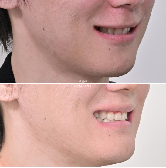돌출입 수술 ASO + 인비절라인 라이트 후교정 치료기간 10개월 관련 이미지 19