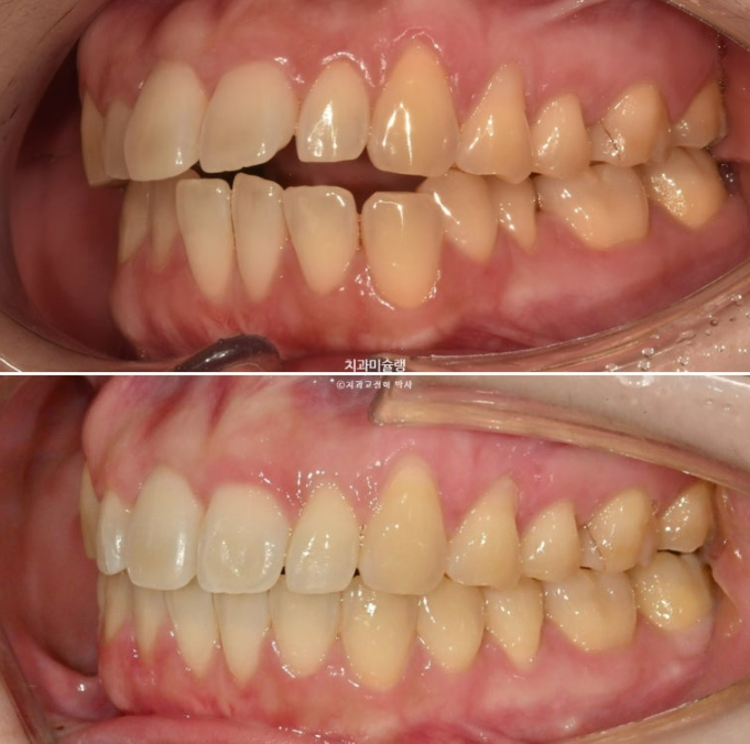 비발치 인비절라인 교정 편측 개방교합 가위교합 돌출 재교정 관련 이미지 20