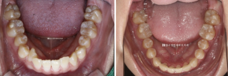 옥니교정 / 웃을때 아랫니만 보여요. 앞니 노출도 교정? 관련 이미지 10