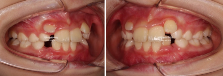어린이 무턱 성장교정 덧니 인비절라인 퍼스트 악궁확장 치료기간 2년 관련 이미지 3