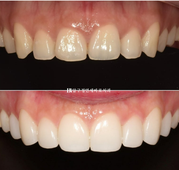 How to Create a Beautiful Smile Line? | A Real Case of Changing a Smile with No-Prep Laminates image 9