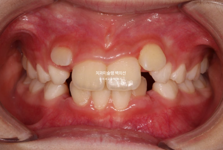 어린이 무턱 성장교정 덧니 인비절라인 퍼스트 악궁확장 치료기간 2년 관련 이미지 2