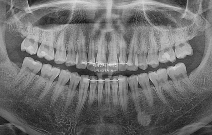 앞니 부분교정 덧니 교정 블랙트라이앵글 부정교합 마모 시뮬레이션 치료기간 5개월 관련 이미지 20