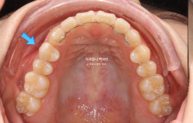 법랑질형성부전 앞니, 인비절라인 교정과 무삭제 라미네이트 젤라미 치료 증례 관련 이미지 10