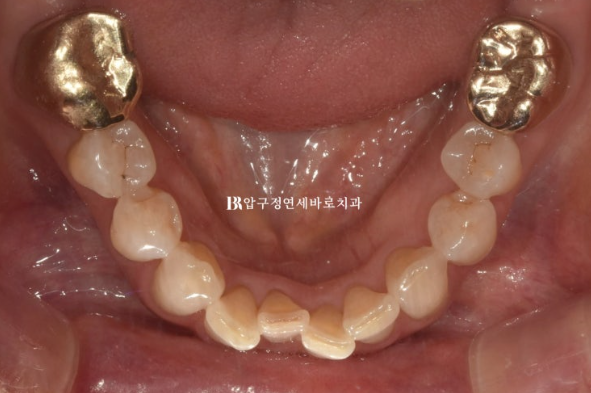 50s Invisalign Lite No-Prep Laminate Bunny Teeth image 5