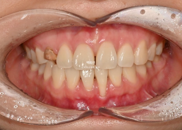 매복 결손 잔존유치 라미네이트 크라운 캔팅 인비절라인 라이트 치료 관련 이미지 2
