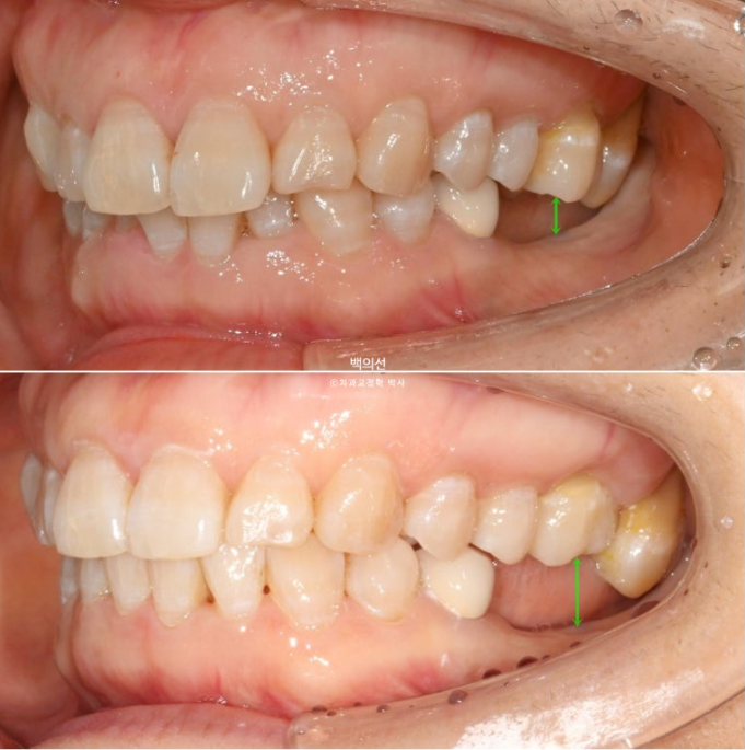 40대 인비절라인 라이트 앞니 돌출 과개교합 덧니 교정 후기 관련 이미지 17
