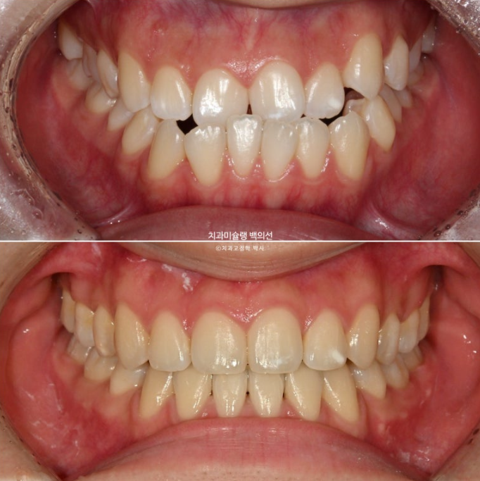 비수술 주걱턱 비대칭 발치 교정 결손치 반대교합 클리피씨 치료기간 1년 11개월 관련 이미지 13