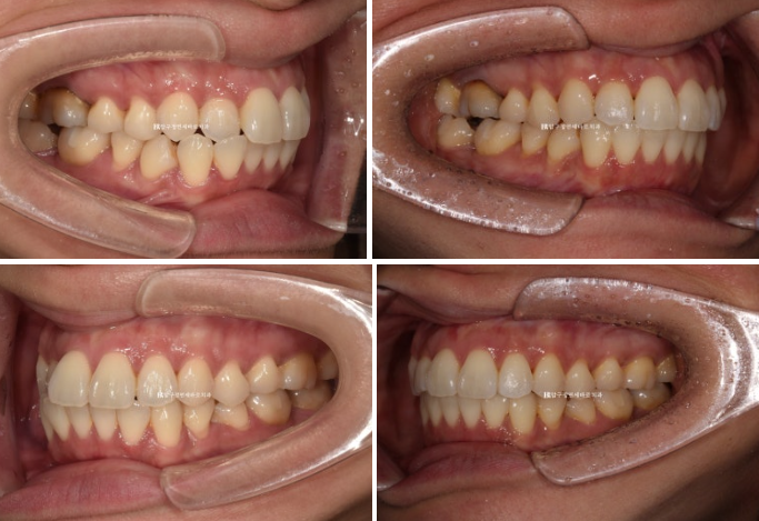 Short-Term Orthodontic Treatment Period for an Overseas Korean in Their 40s with Anterior Crossbite and Buck Teeth image 8