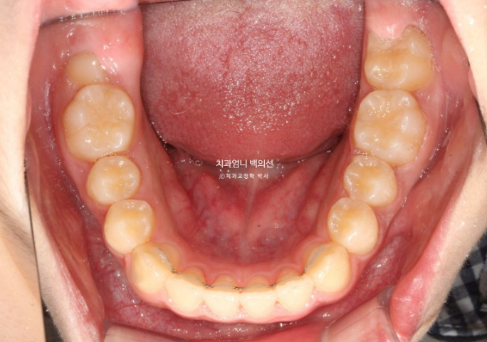 어린이 투명교정 인비절라인 퍼스트 가위교합 돌출교정 덧니교정 관련 이미지 11