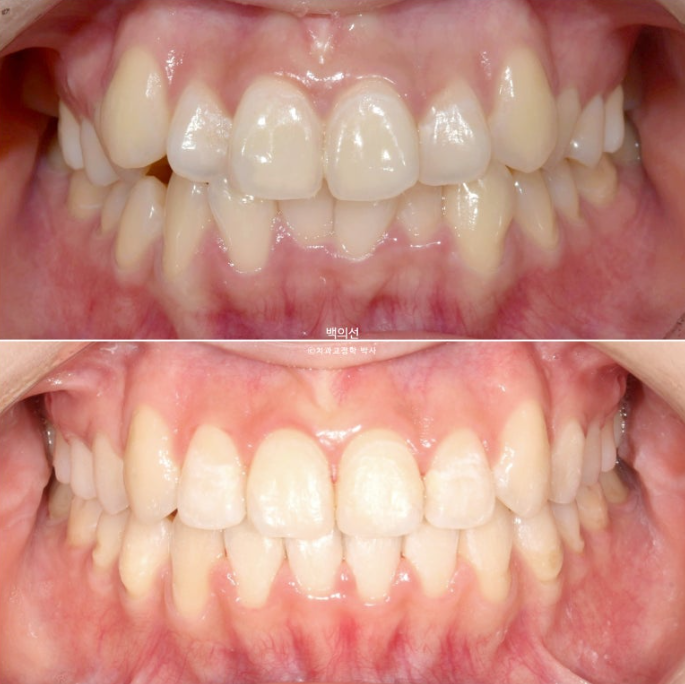 비발치 덧니교정 인비절라인 교정 사랑니 이용 교정 관련 이미지 17