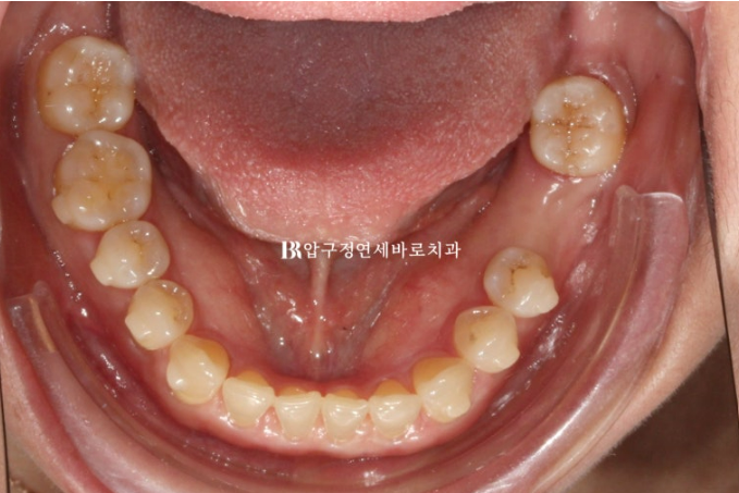 벌어진 치아 교정 인비절라인 라이트 무삭제 라미네이트 치료 관련 이미지 10
