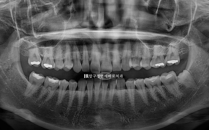 인비절라인 돌출입 발치교정 거미스마일 잇몸미소 교정 관련 이미지 16