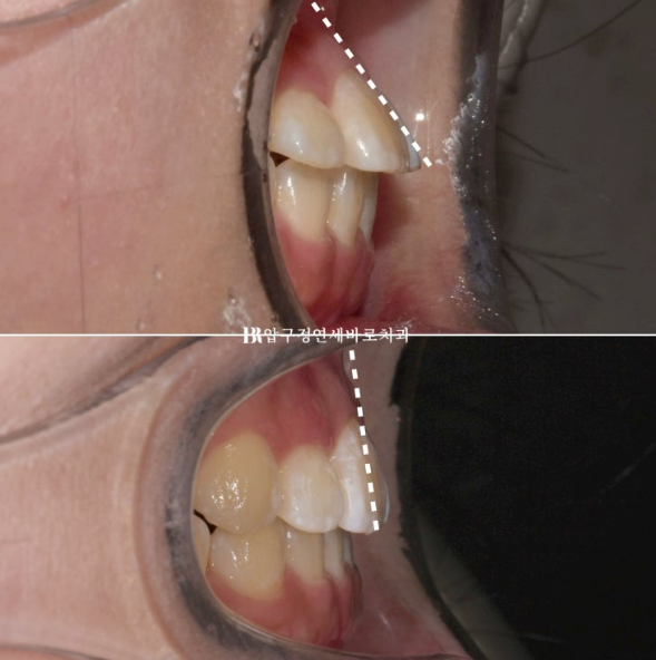 서울 인비절라인 치과 재교정 뻐드렁니 교정 관련 이미지 7