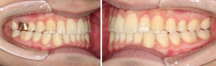 인비절라인 비발치 앞니 돌출 덧니 교정 ? 관련 이미지 10