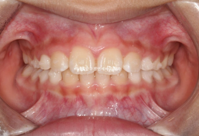 무턱교정 어린이 투명교정 인비절라인 퍼스트 교정 후기 관련 이미지 5