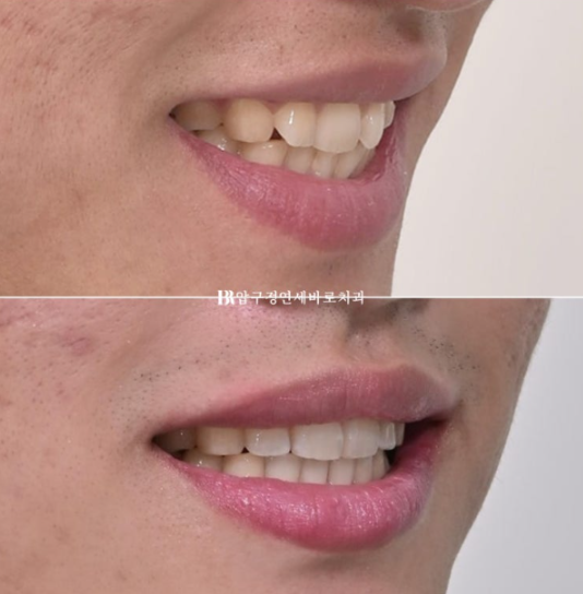 인비절라인 라이트 교정 덧니 이소맹출 반대교합 관련 이미지 13