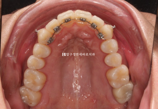 결혼식 6개월 전, 교정 시작해도 될까요? 관련 이미지 9