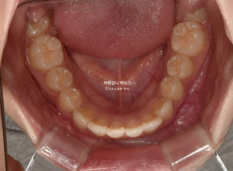 입이 안 다물어짐 입술부전증 호두턱 교정? 관련 이미지 5