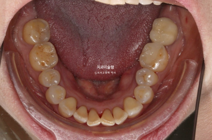 50대 치아교정 돌출 치아벌어짐 중년교정 관련 이미지 7
